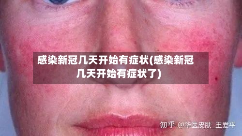 感染新冠几天开始有症状(感染新冠几天开始有症状了)